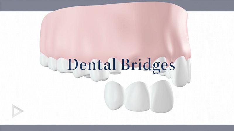 Dental Bridges