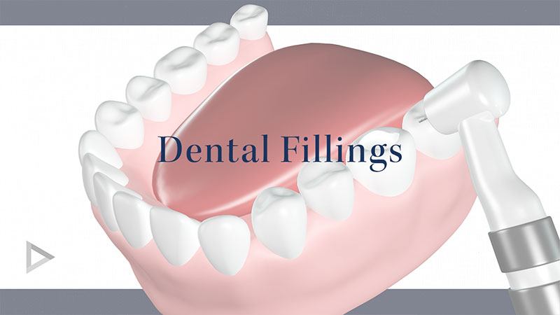 Dental Fillings