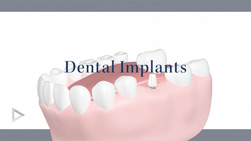 Dental Implants