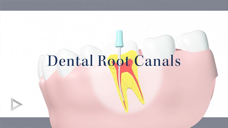 Root Canal