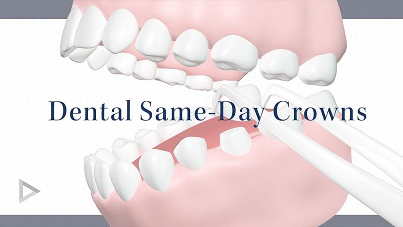 Same Day Crowns