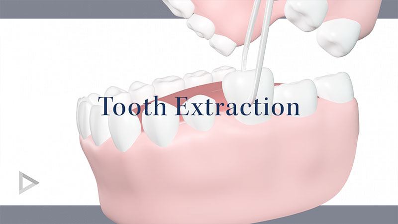 Tooth Extraction