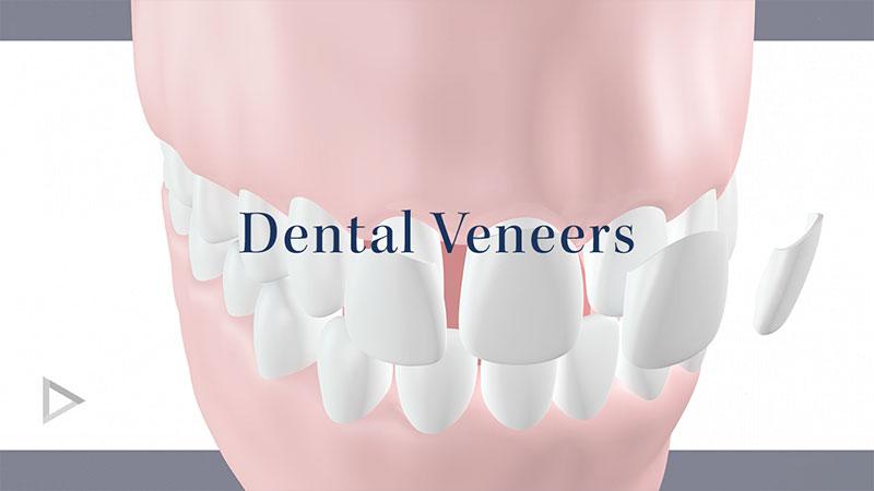 Dental Veneers